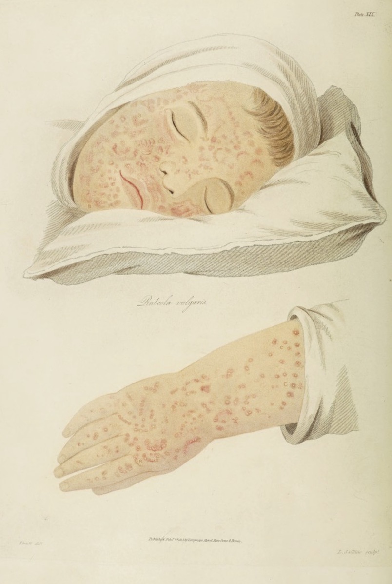 Illustration of measles