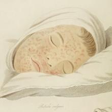 Thumbnail image of illustration of measles